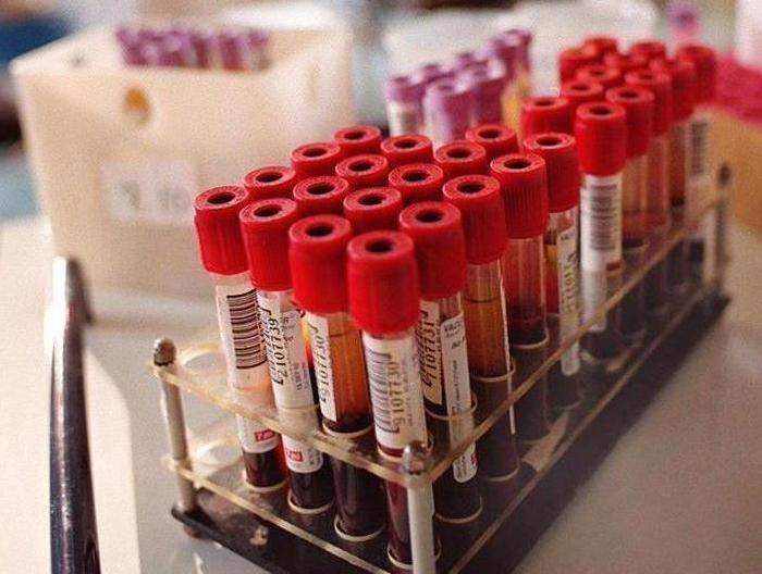 Epilessia, prelievo sangue rivela risposta bimbi a farmaci